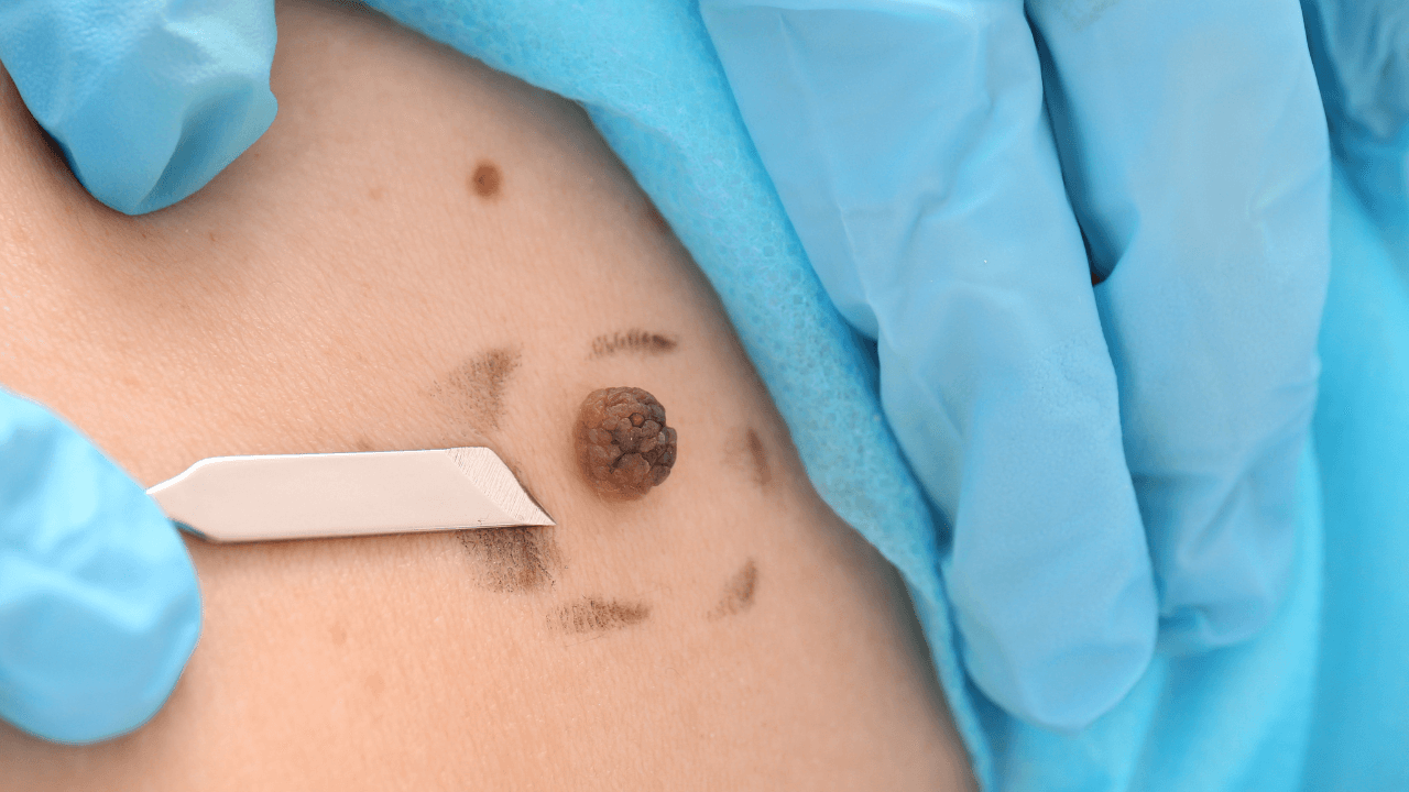 Skin Cancer Types: From Basal Cell Carcinoma to Melanoma