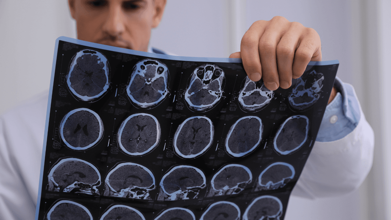 Multiple Sclerosis Risk: The Surprising Role of Primary Care