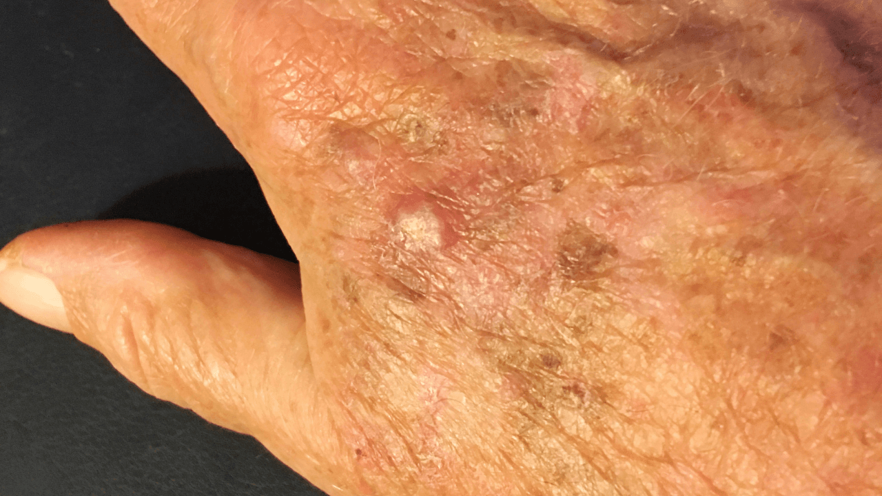 The Comprehensive Guide to Understanding Skin Cancer