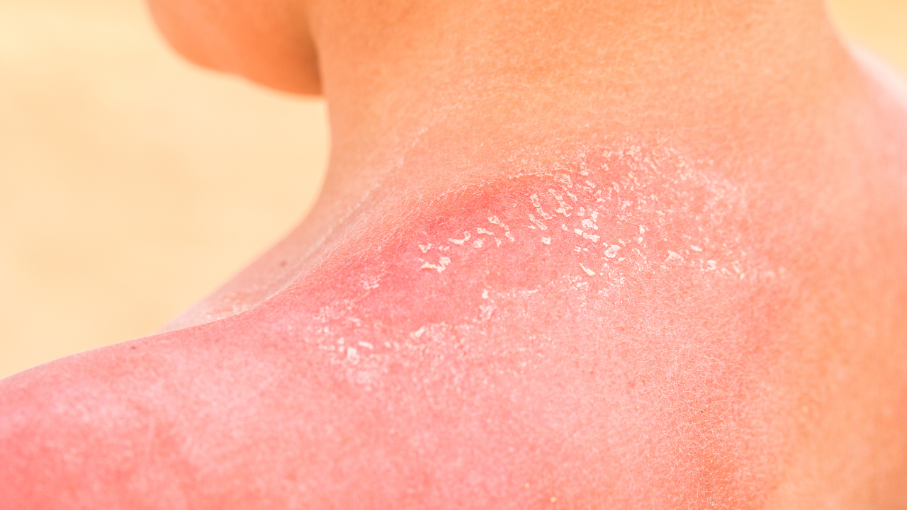 How to Protect Your Skin: Causes and Prevention of Skin Cancer