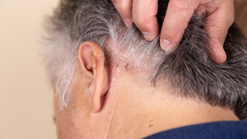 Skin cancer on the scalp 2