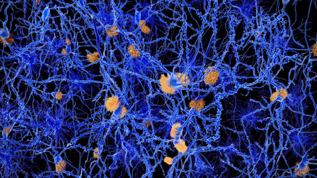 Alzheimer's disease. Computer illustration of amyloid plaques amongst neurons. Amyloid plaques are characteristic features of Alzheimers disease